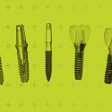 sisteme-implanturi-dentare.jpg