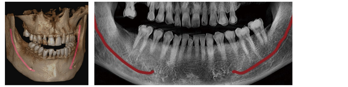 Dentium Rainbow™ CT