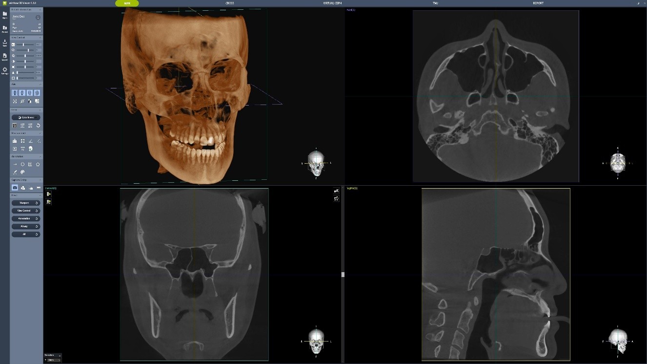 Dentium Rainbow™ CT 2