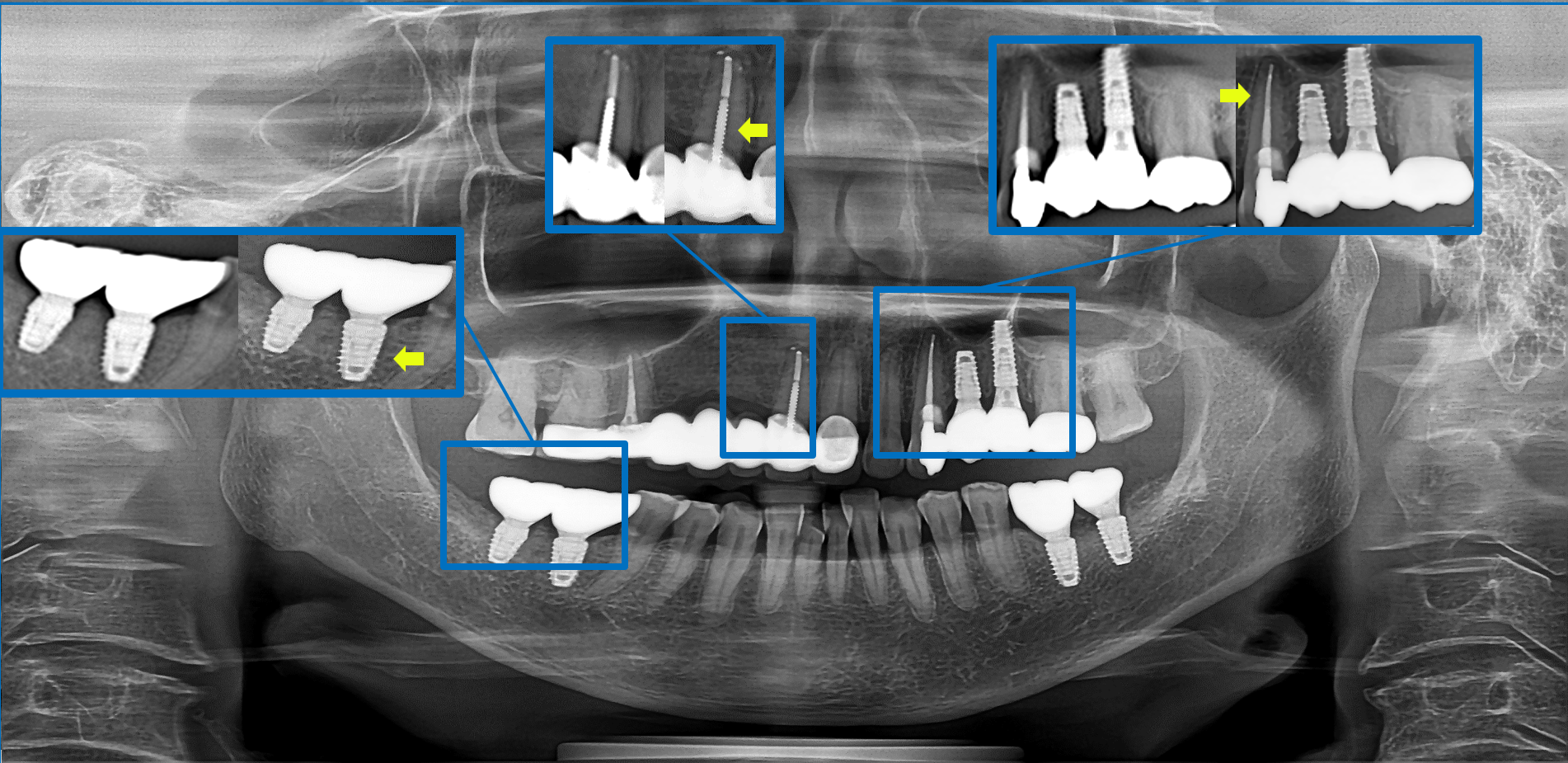 Dentium Rainbow™ CT 2