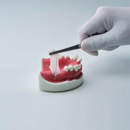 Membrana Purgo Xtend Membrana Purgo Xtend