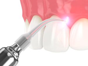 Aplicatie laser dioda stomatologie