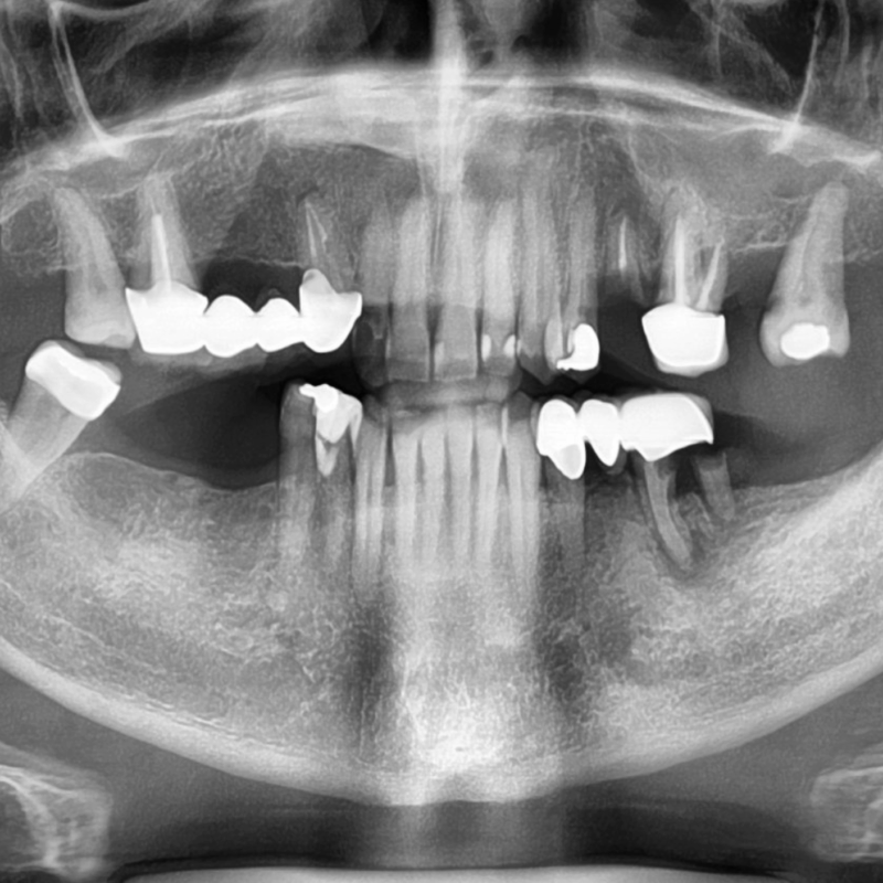 CBCT