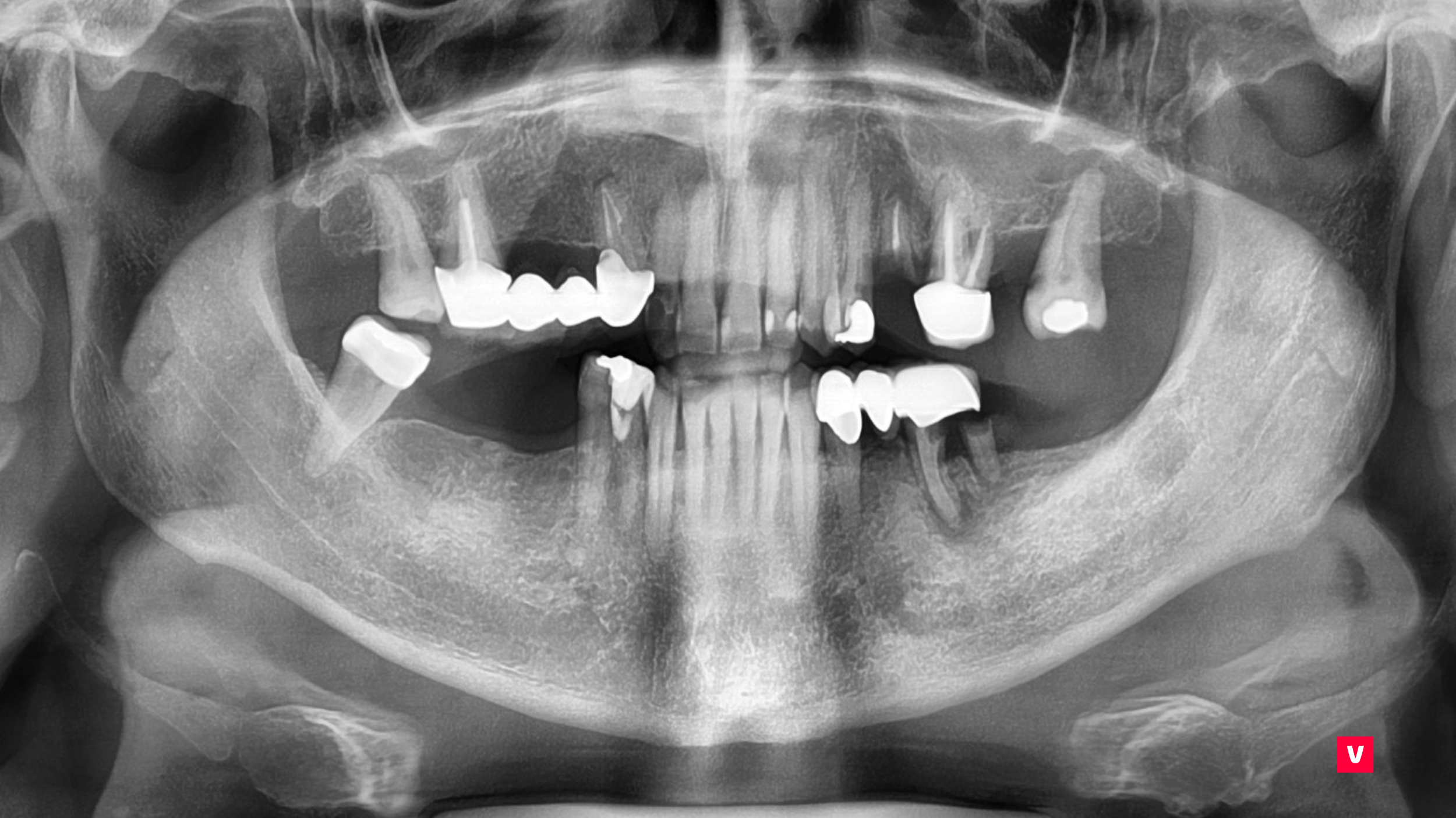Dinte ascuns în maxilar: Cum a ajutat CBCT la prevenirea complicațiilor