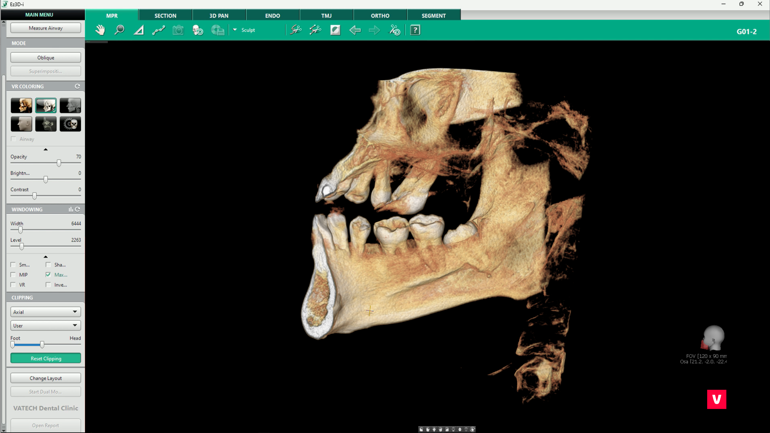 software Vatech, Ez3D-i