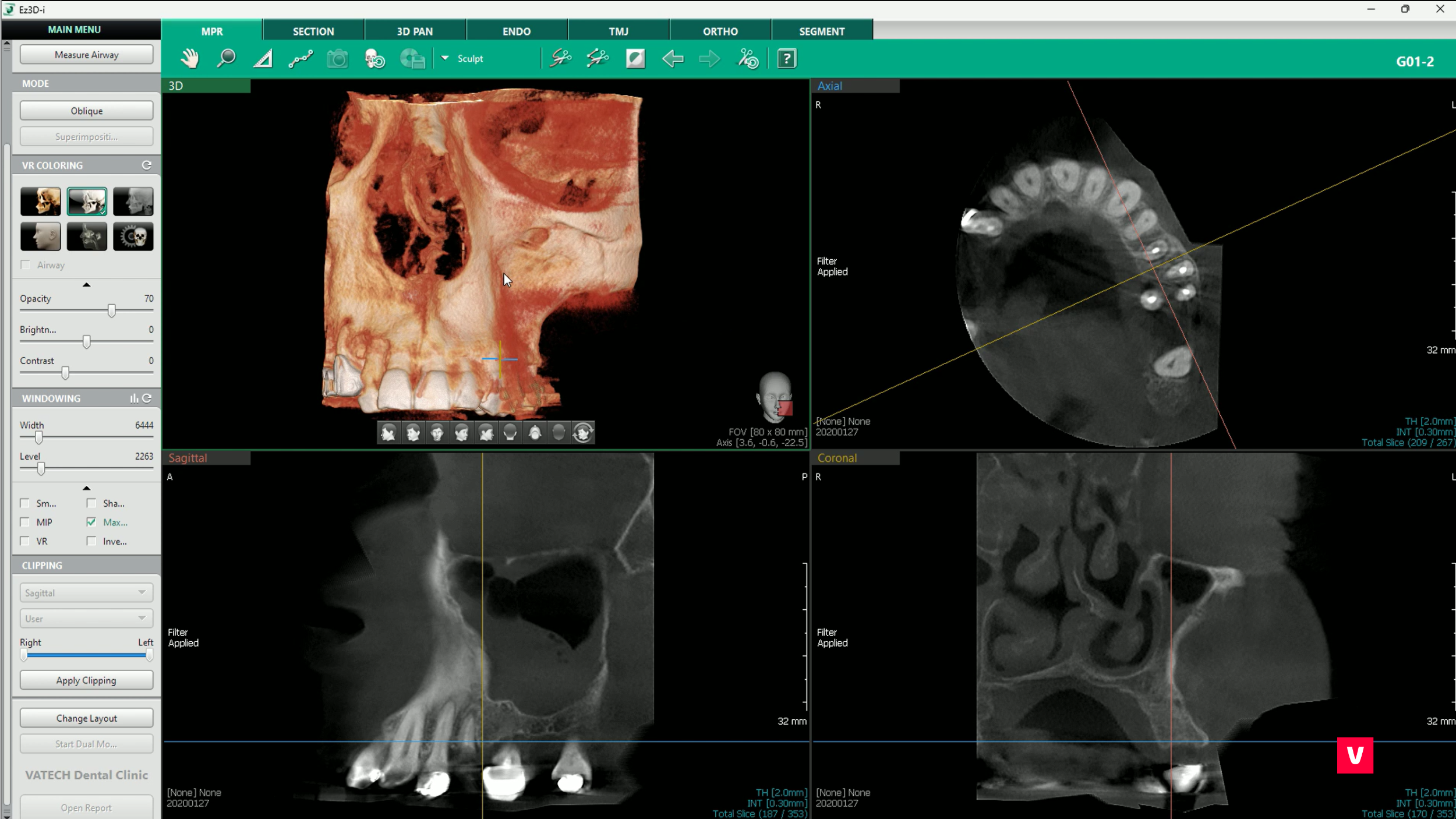 software Vatech, Ez3D-i