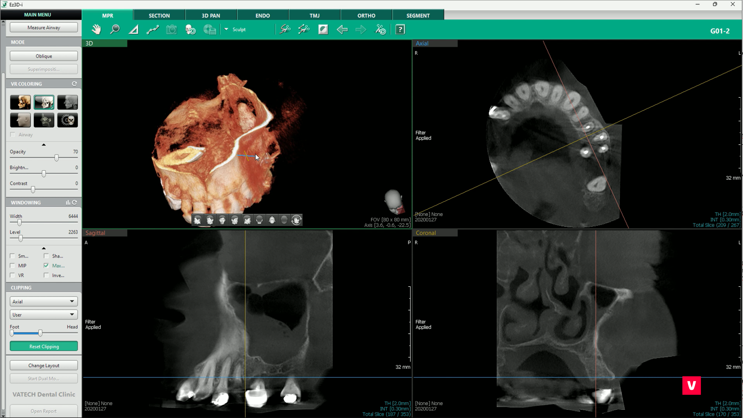 software Vatech, Ez3D-i