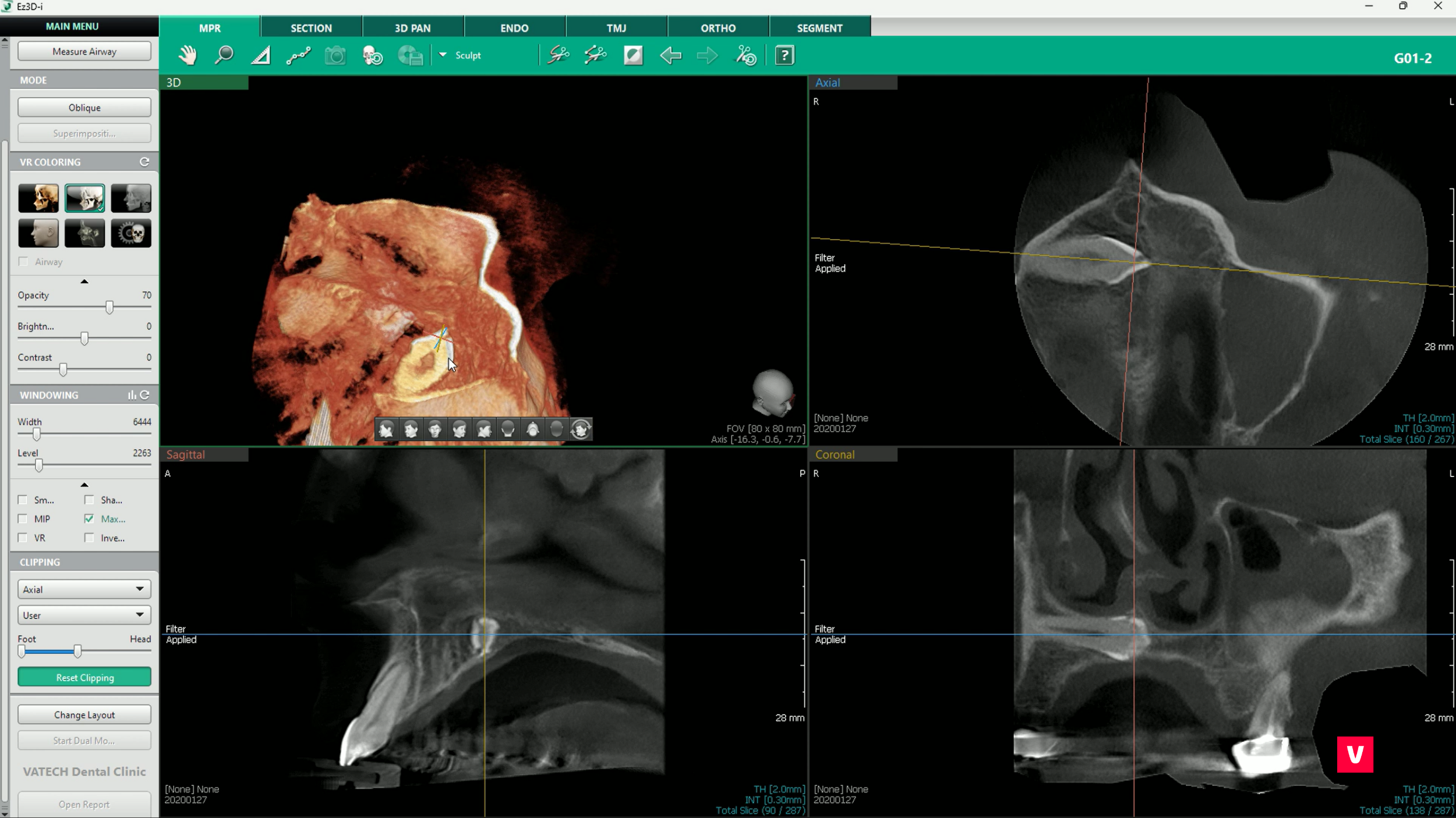 software Vatech, Ez3D-i
