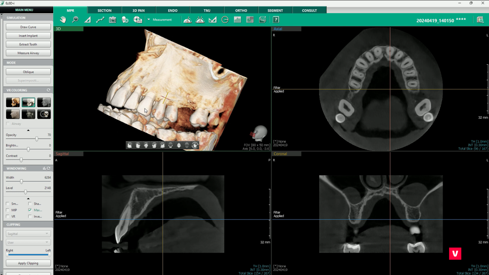 cbct dinte fractura