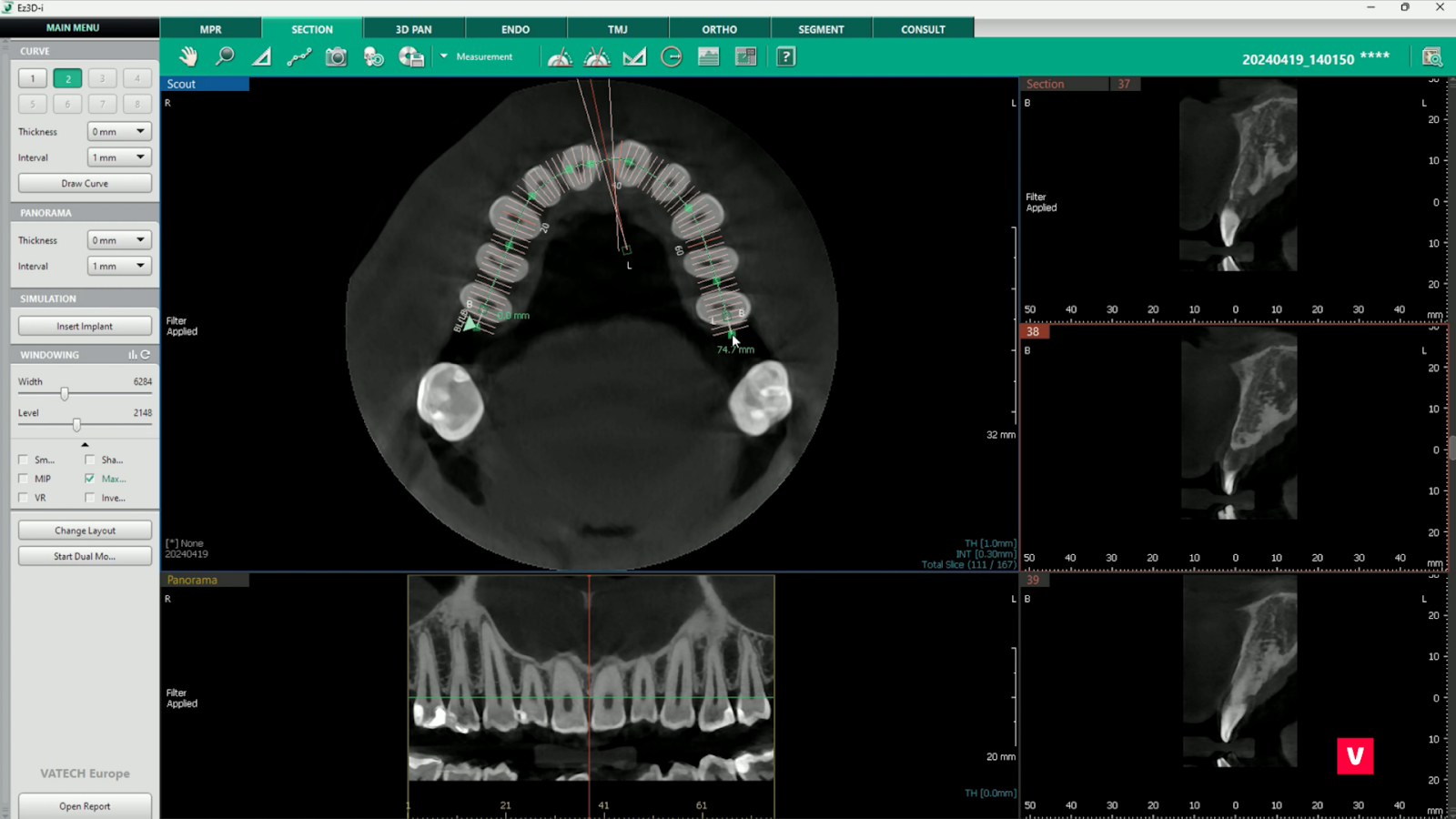 cbct