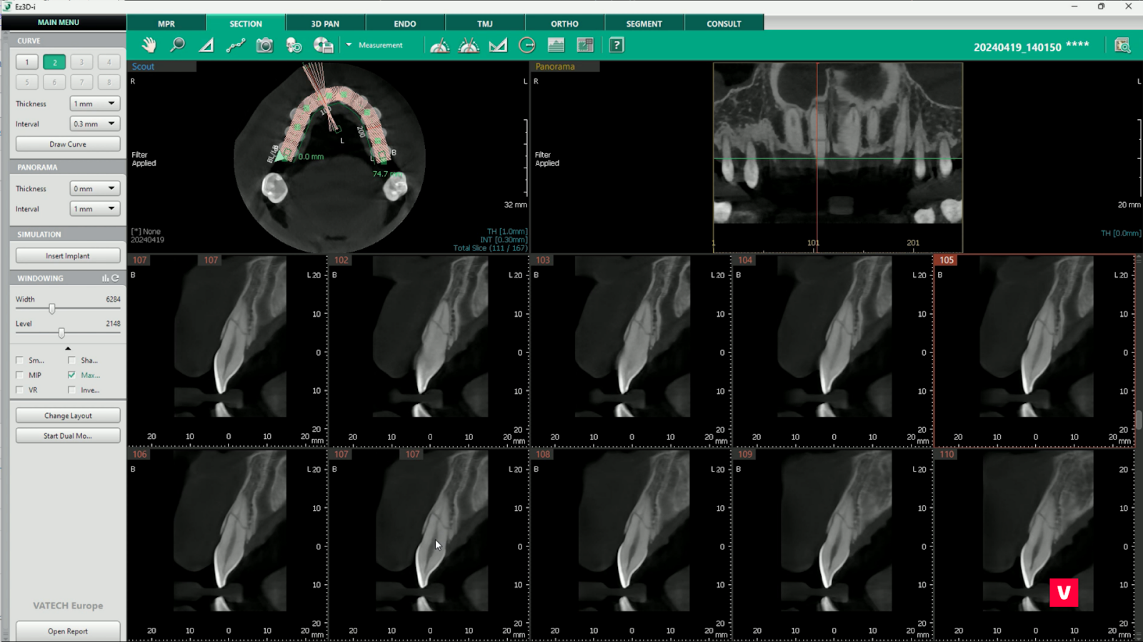 fractura dinte 11 cbct