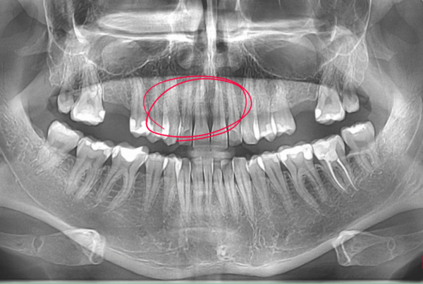 fractura dinte cbct
