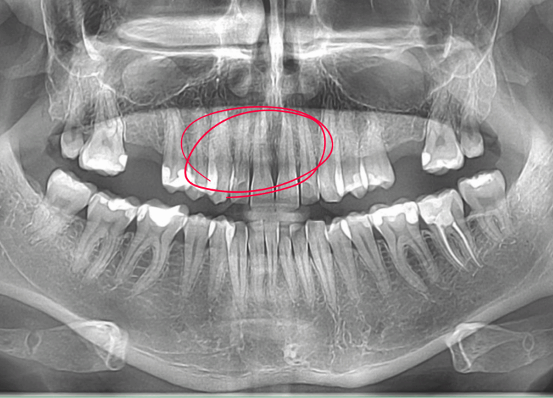 fractura dinte cbct