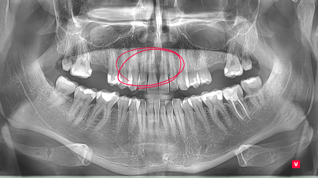 Cum poate CBCT dezvălui fracturile ascunse: Cazul dintelui 11
