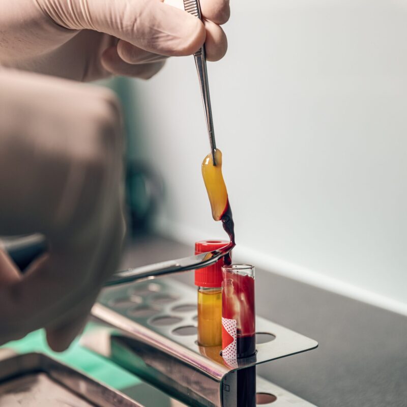 PRF-Platelet-Rich-Fibrin