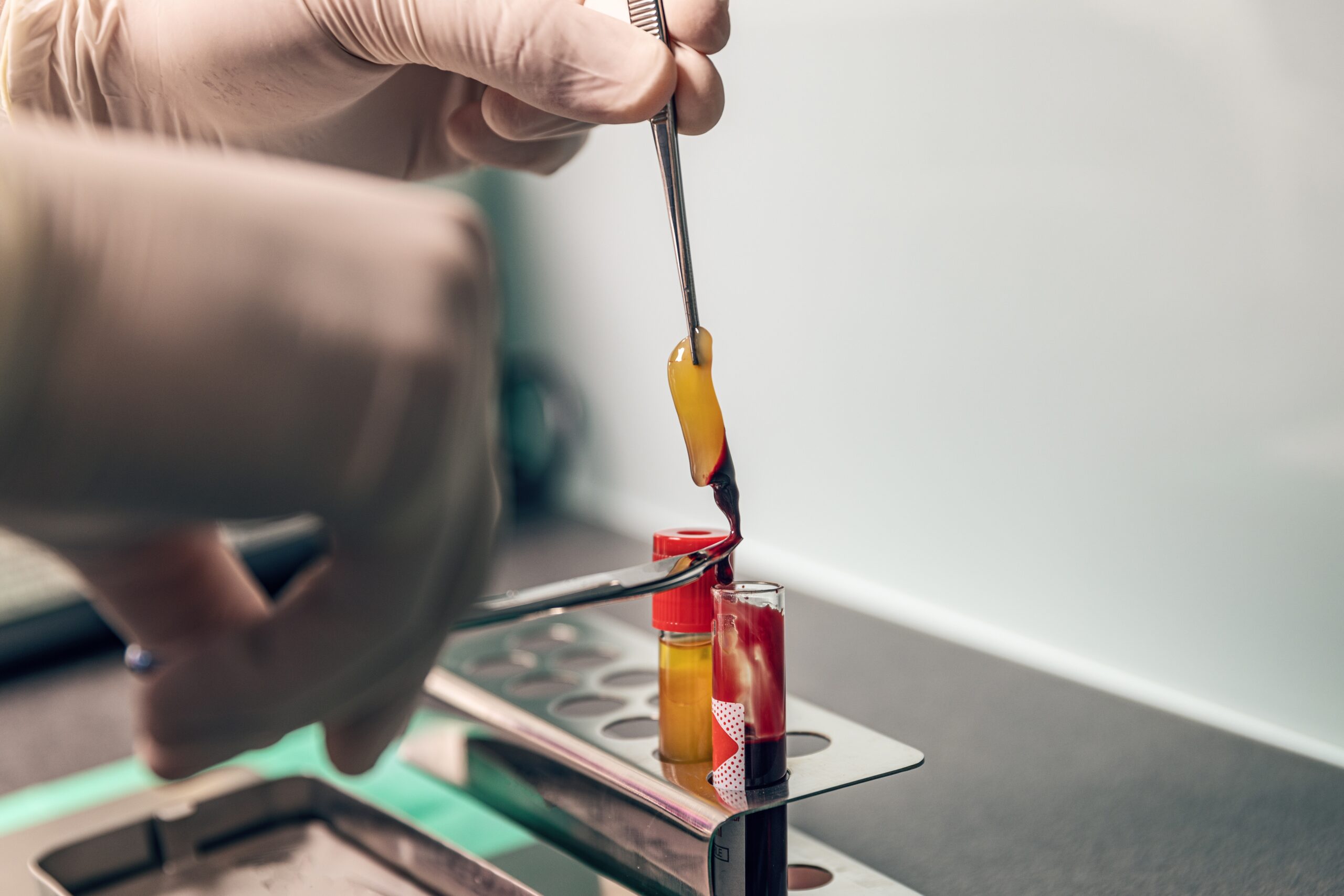 PRF: Soluția naturală pentru vindecare accelerată în stomatologie