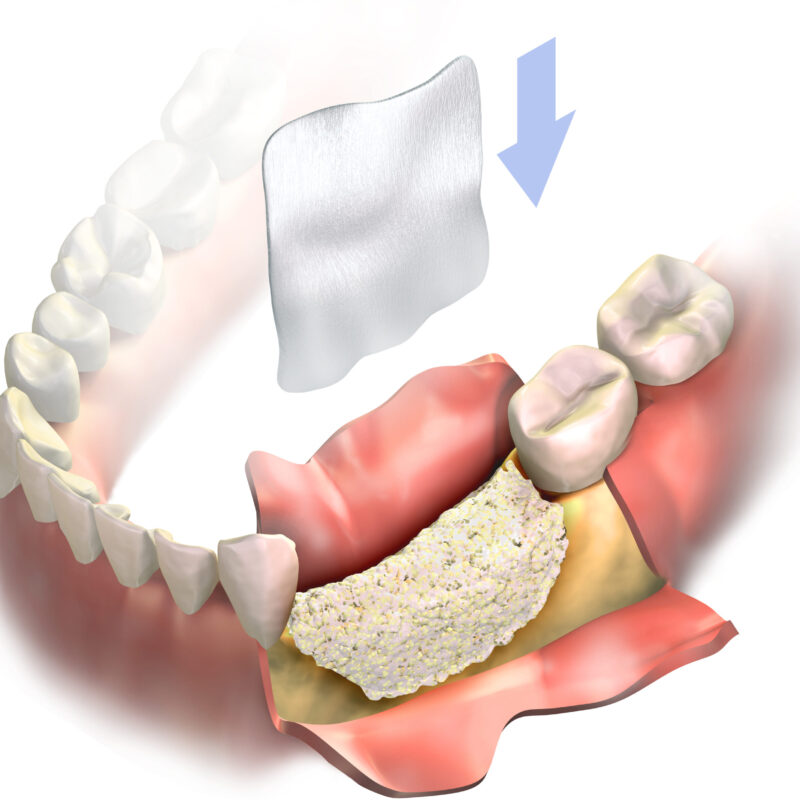 Membrana-de-colagen
