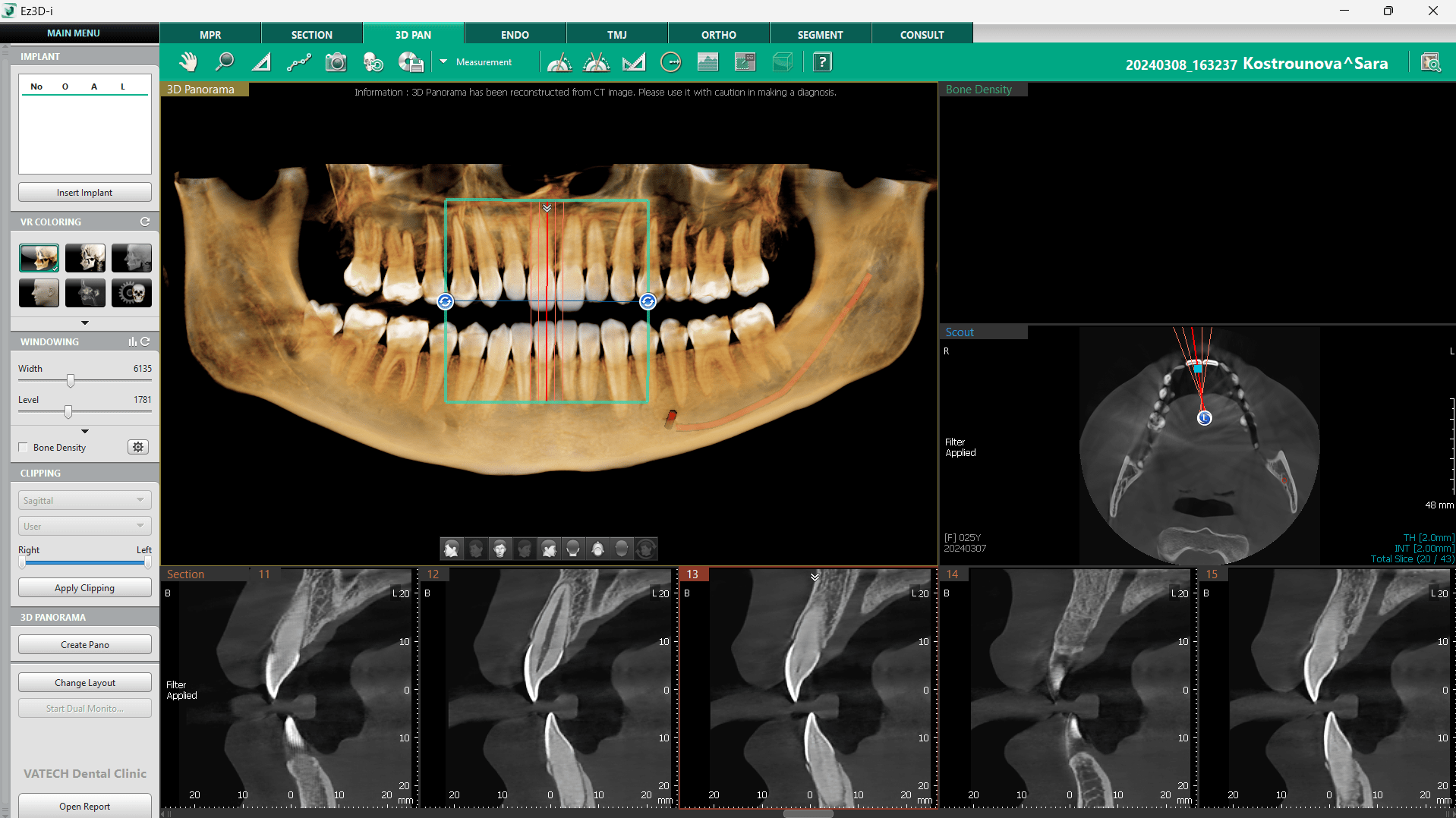 CBCT-implantologie