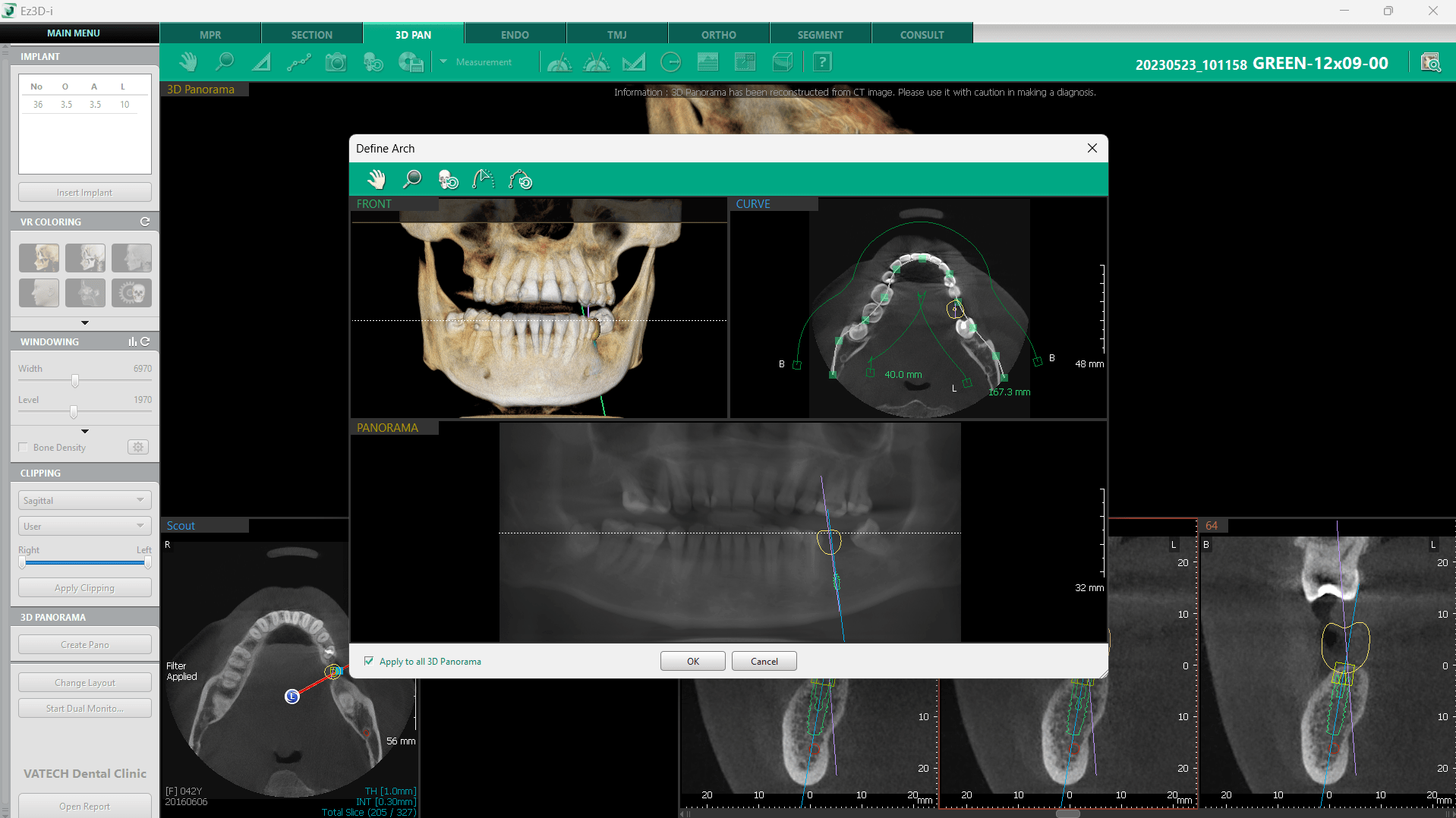 CBCT-implantologie