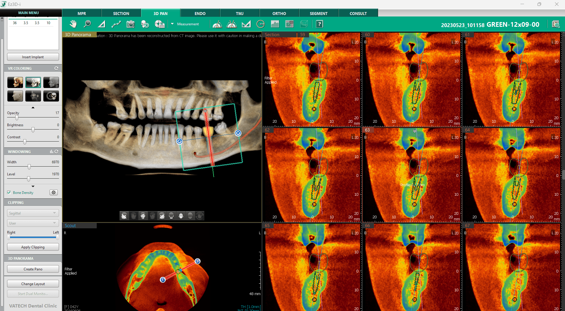 CBCT-implantologie