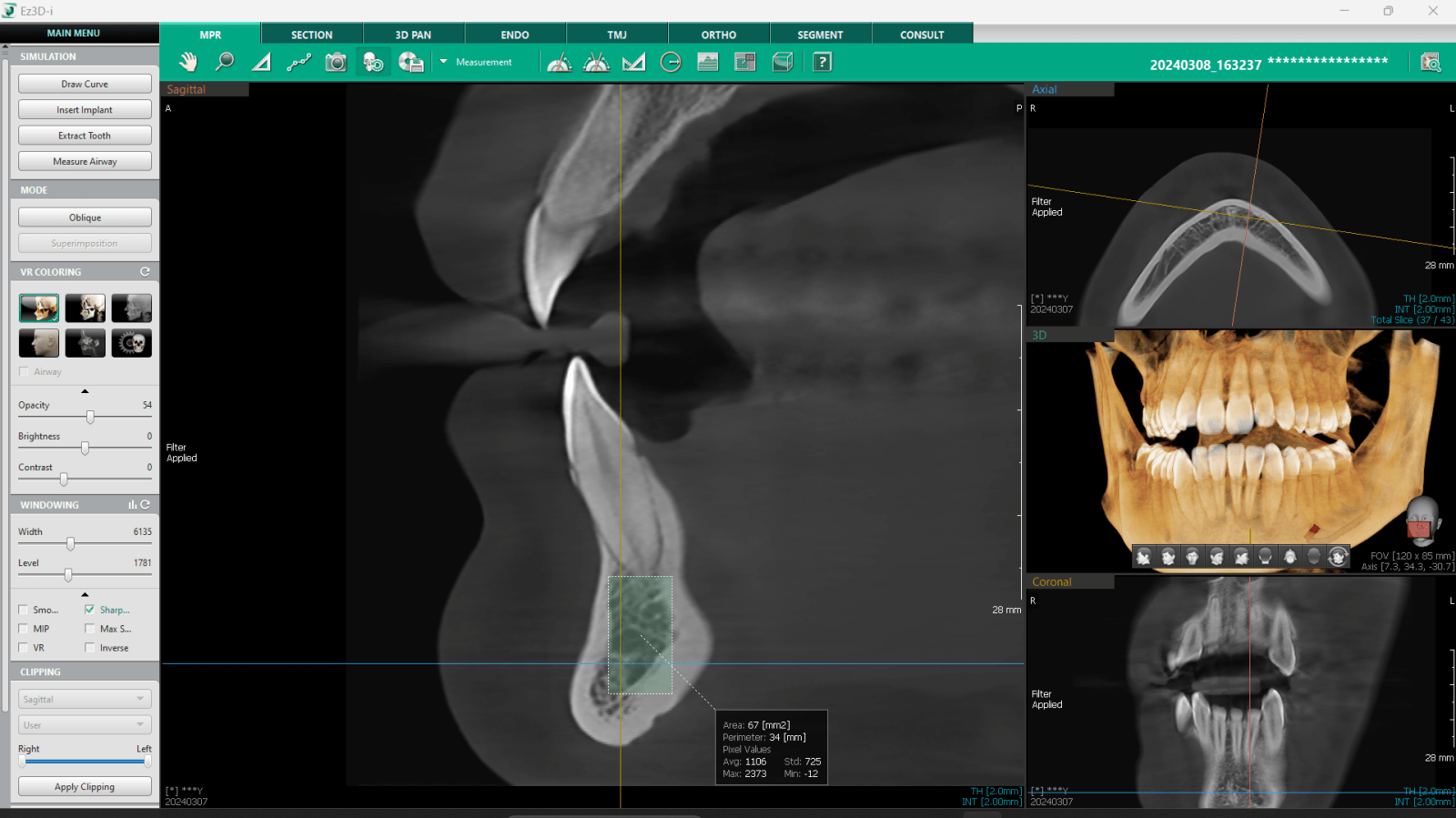 CBCT-implantologie