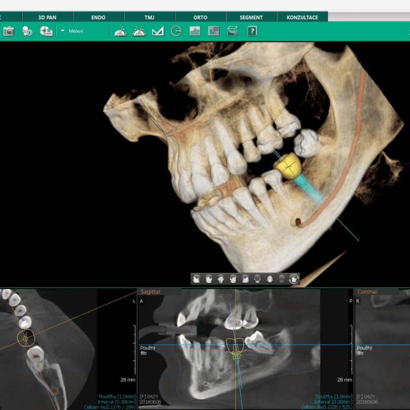 CBCT-implantologie