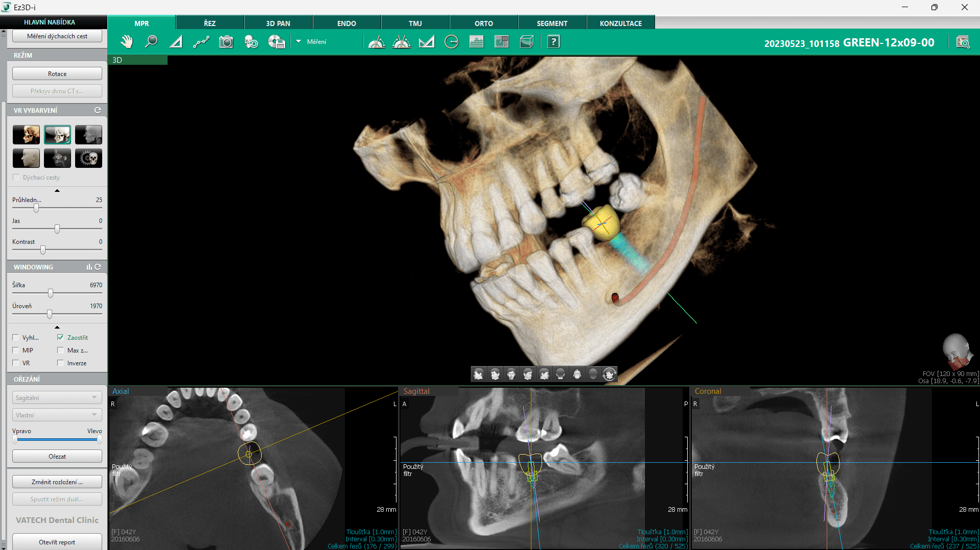 CBCT în implantologie: de la diagnostic la planificare detaliată
