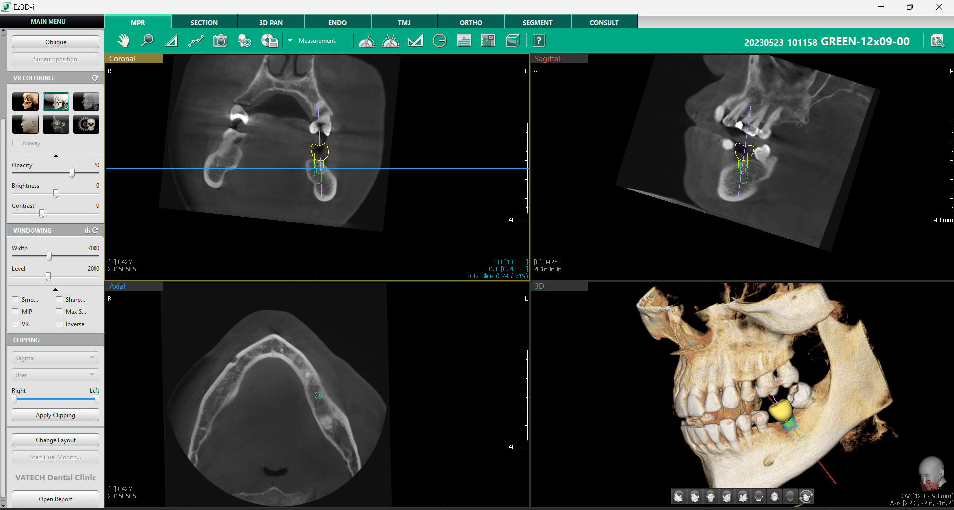implantologia-moderna-3D