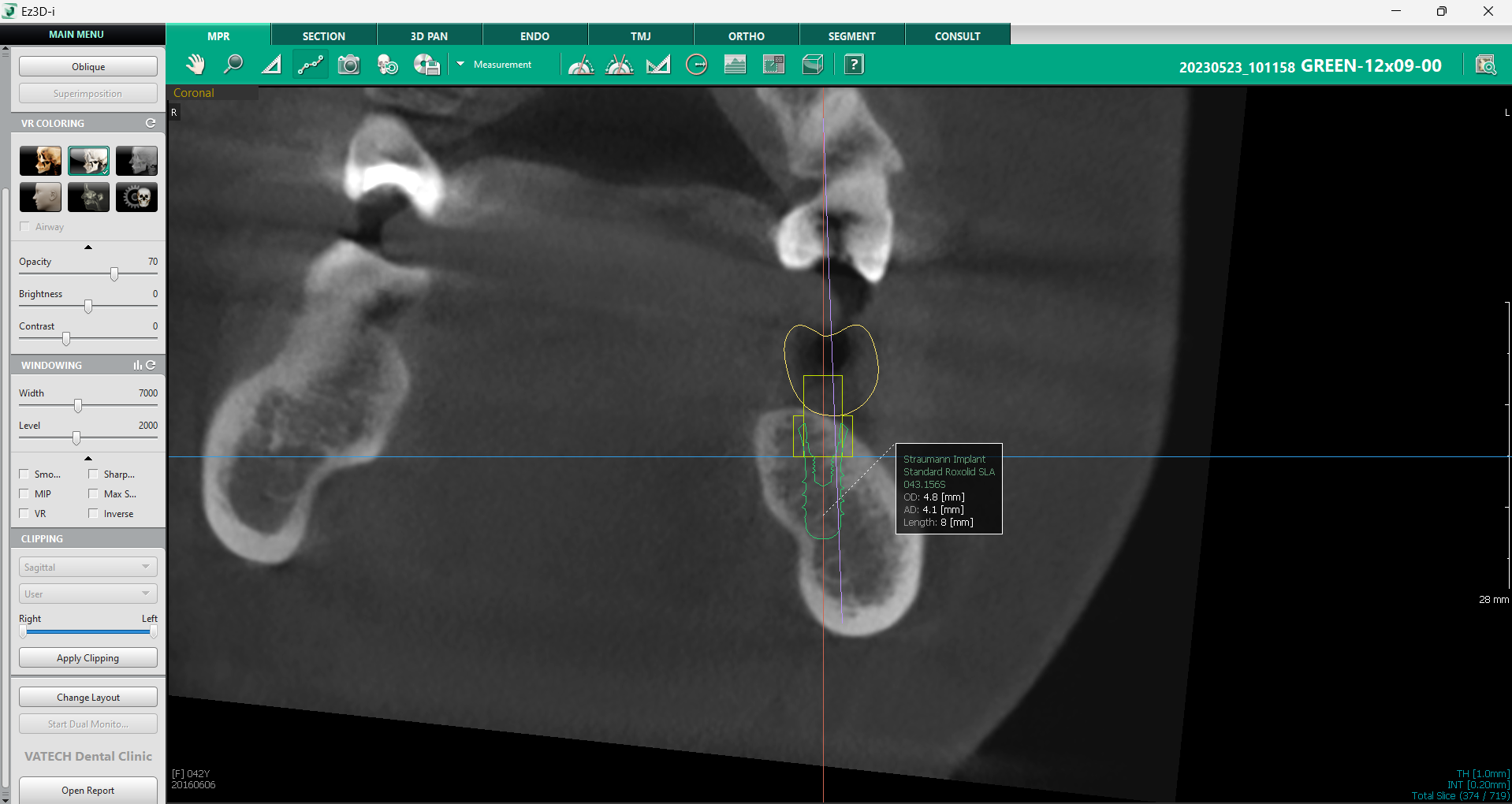 implantologia-moderna-3D