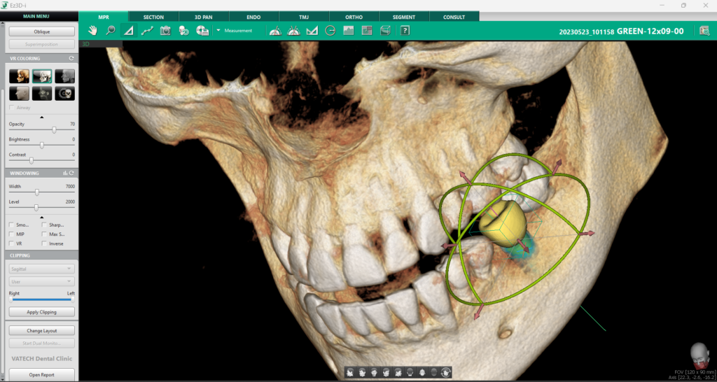 Implantologia modernă: Optimizarea plasării implanturilor cu imagistica 3D