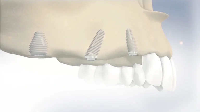 Implanturi Co Axis