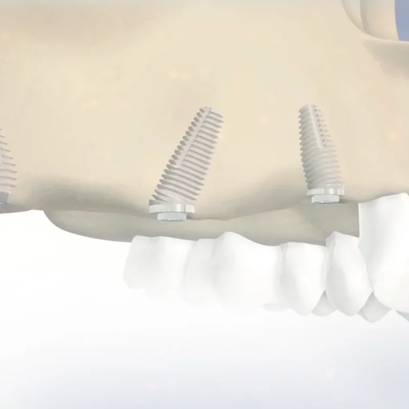 Implanturi Co Axis