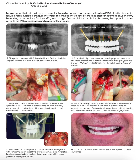 prezentare caz cu implanturi zigomatice Southern Implants