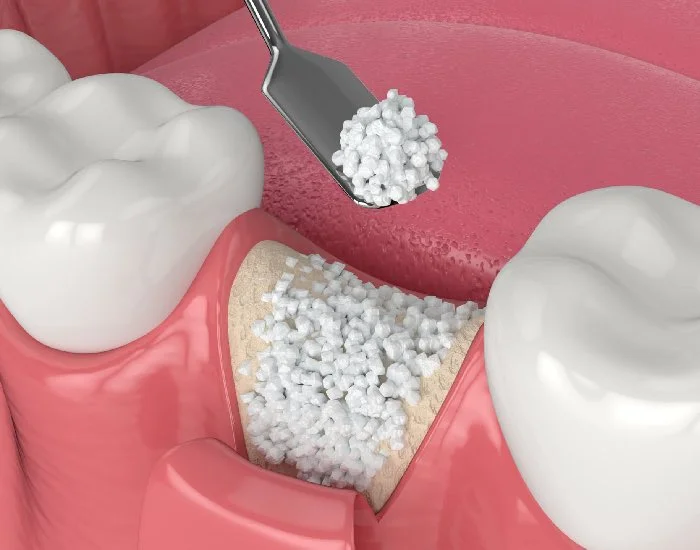 Aditie De Os Dentar