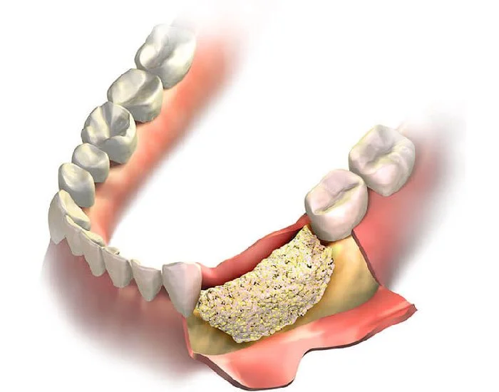 Augmentare Osoasa