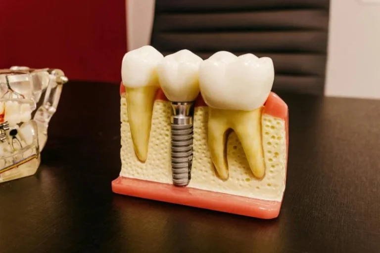 model miniatural de implant dentar, asezat pe birou