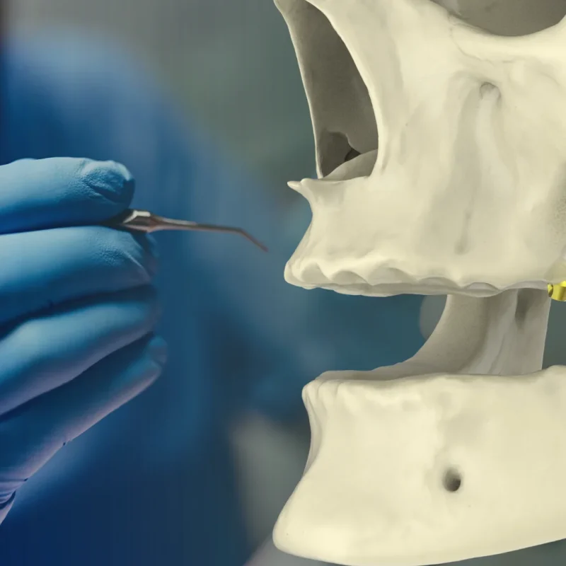 Implanturi Pterigoidiene Southern Implants