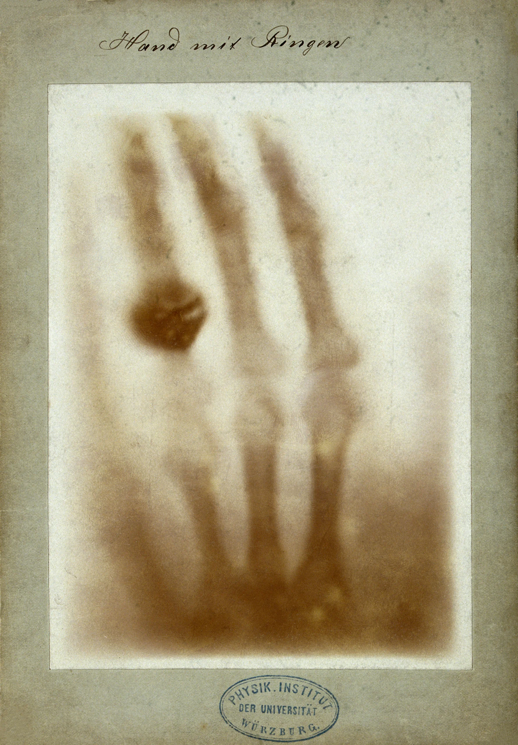 First Medical X Ray By Wilhelm Röntgen Of His Wife Anna Bertha Ludwig’s Hand   18951222