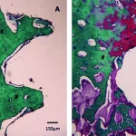 Histological Findings Of Bone Healing In Titanium A And Zirconia B Implants Surface