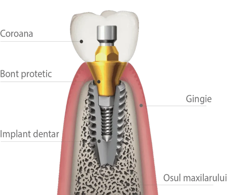 Schita Implant Dentar