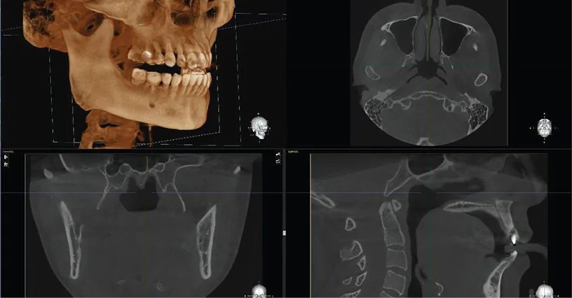 Rainbow™ CT 2 în 1