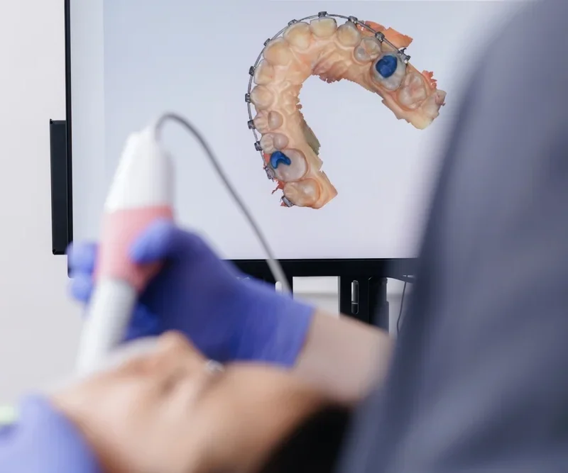Procesul de scanare dentara cu ajutorul unui bont de scanare