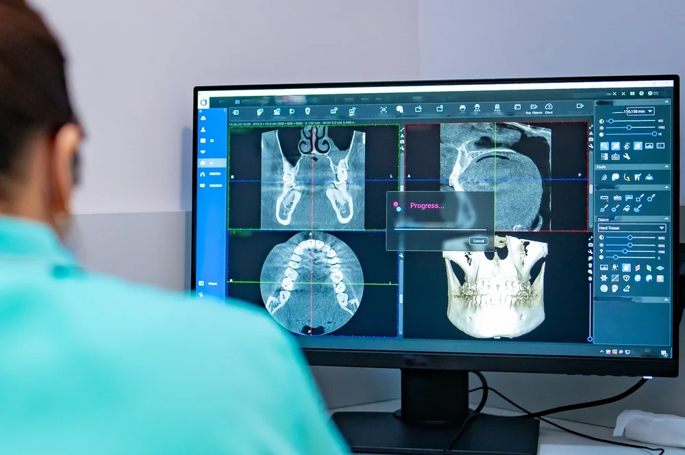 10 beneficii ale investigației CBCT pentru implantologie și chirurgie ghidată