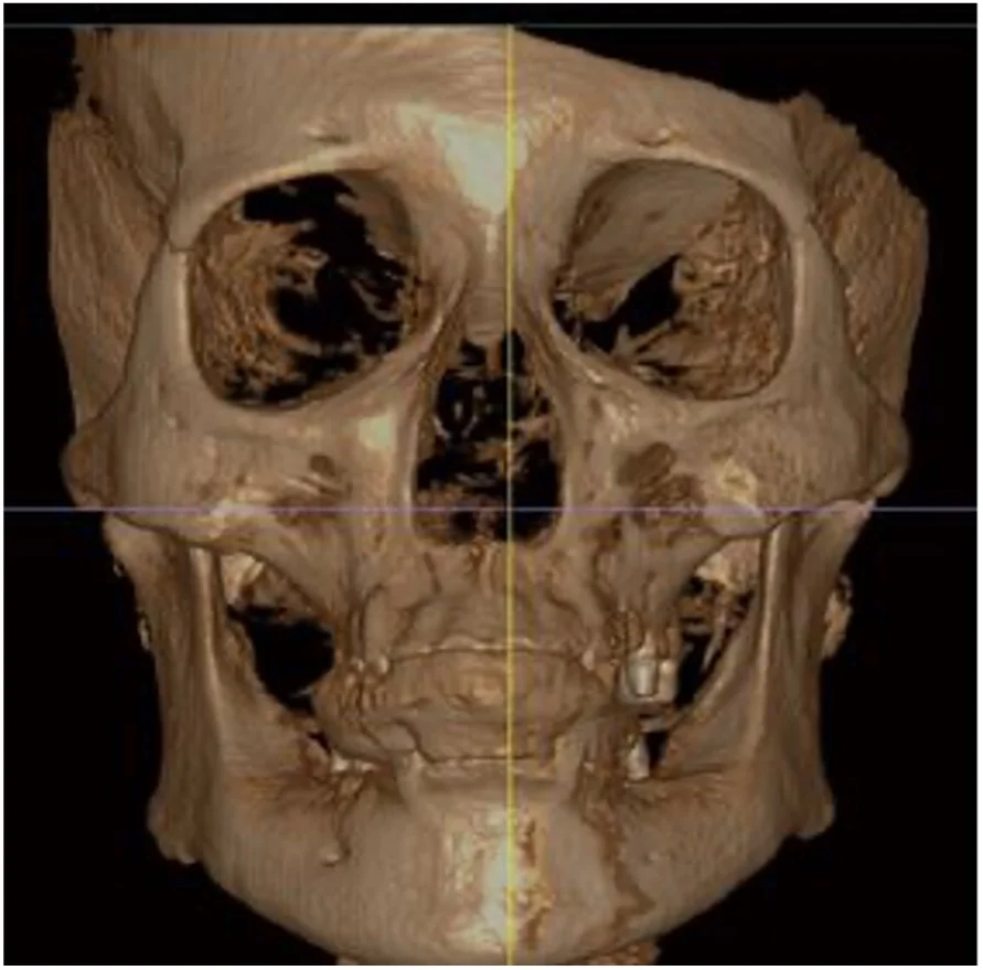 CBCT
