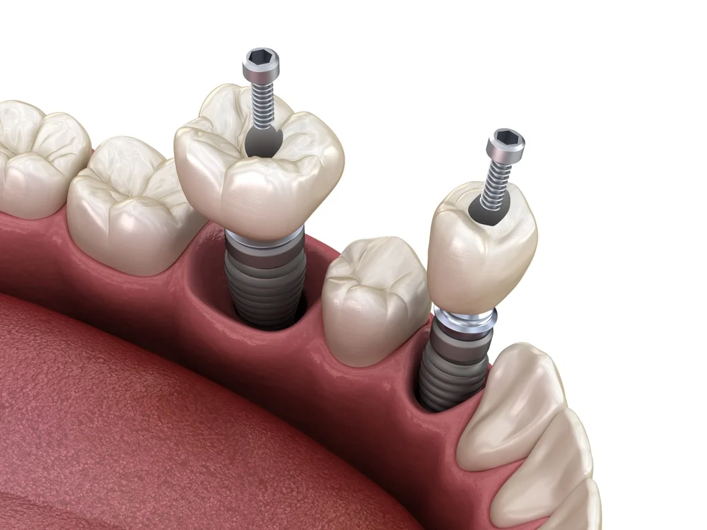Bonturi Dentare