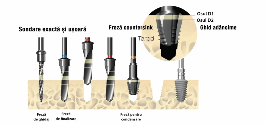 Fixare Sistem Implant Dentium Super Line
